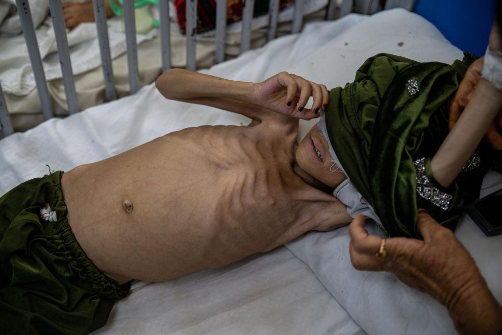 Criança em estado grave de desnutrição recebendo cuidados em um hospital